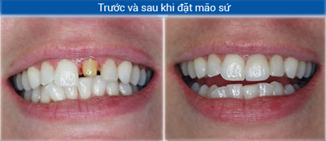 Phục hình răng sứ