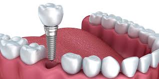 Cấy ghép implant tiêu chuẩn Đức