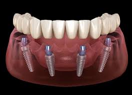 Cấy implant và phục hình truyền thống
