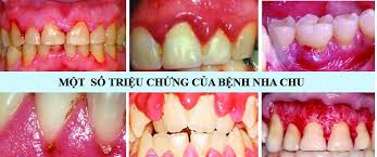 Bệnh Nha Chu