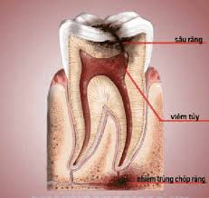 các giai đoạn viêm tủy