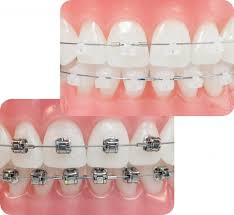 Niềng răng mắc cài sứ thẩm mỹ